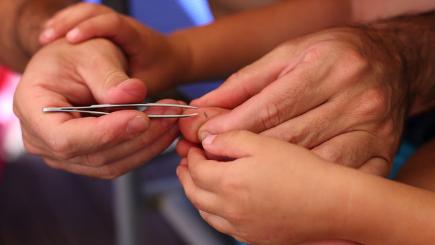 how to remove an embedded splinter from foot