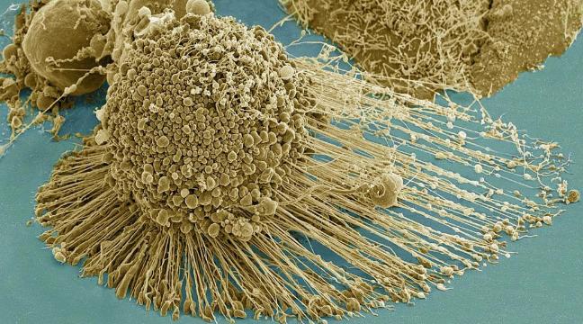 New technique 'breaks the legs' of cancer tumour cells