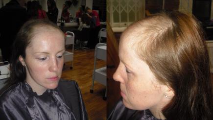 Steroid injections for alopecia areata